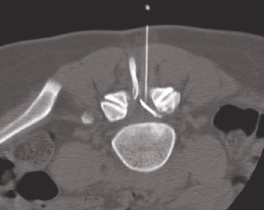 CT gesteuerte Schmerztherapie