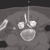 3 PRT intraspinal 3 PRT intraspinal