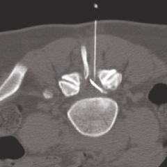 3 prt intraspinal